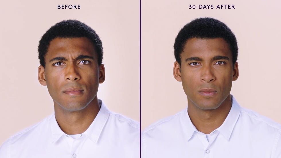Male Facial Rejuvenation | Before and After BOTOX® Cosmetic | wrinkle filler | Face | | Avail Aesthetics in Cary, Raleigh & Wake Forest, NC