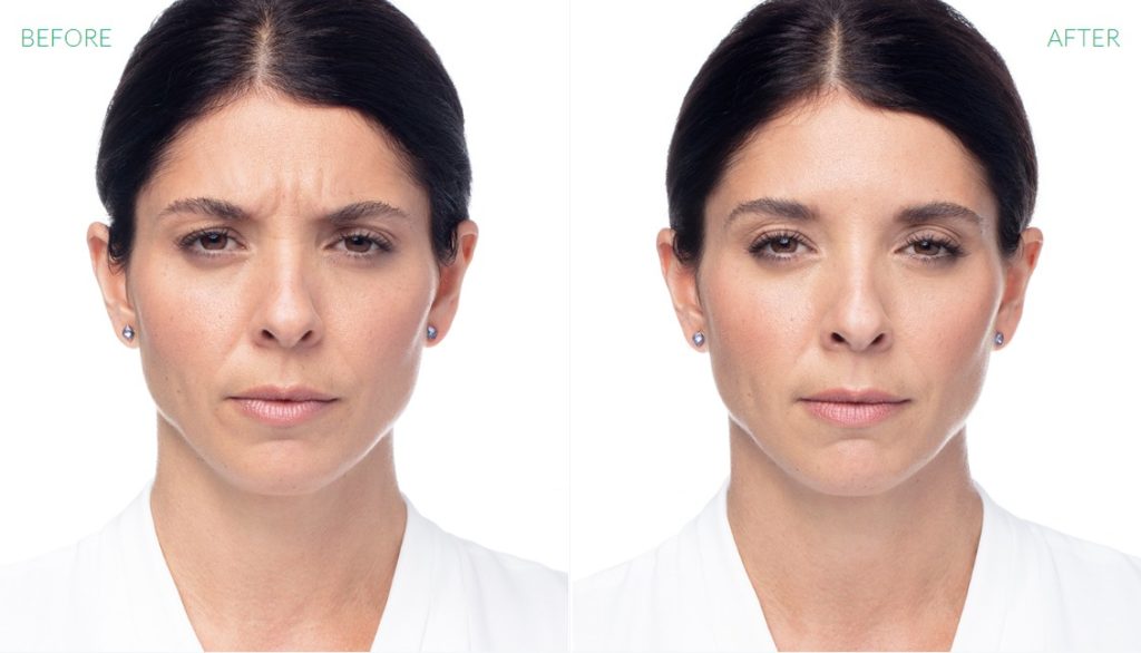 Dysport Treatment Woman Before & After Image | Avail Aesthetics in Wake Forest, NC