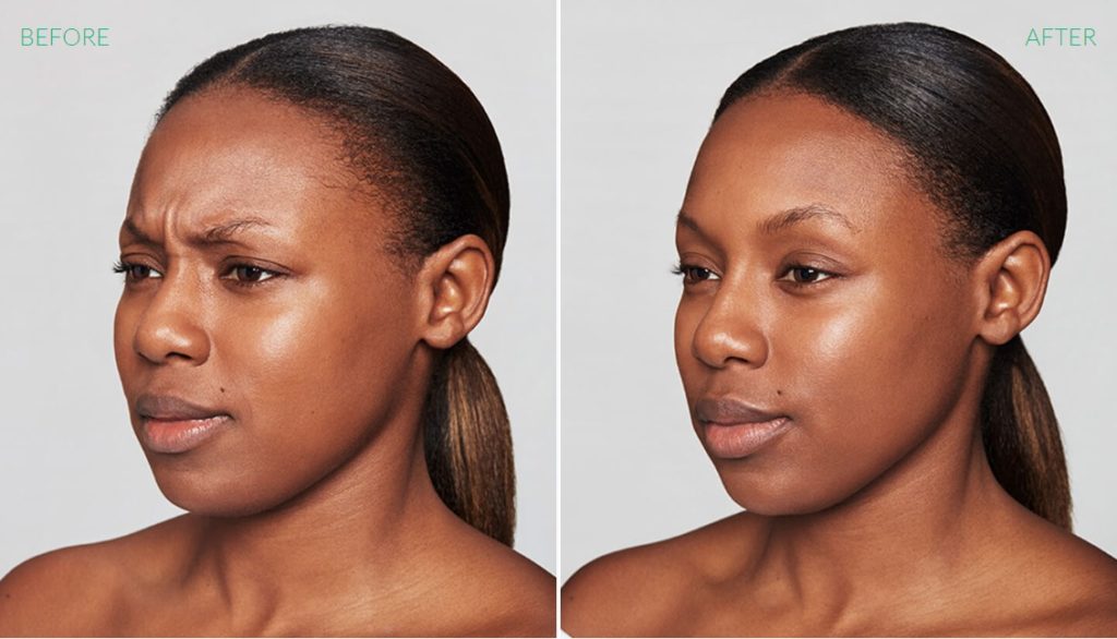 Dysport Treatment Woman Before & After Image | Avail Aesthetics in Wake Forest, NC