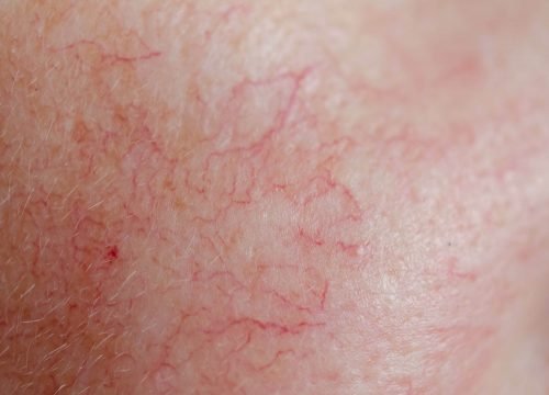 Facial Veins Treatment in North Carolina | Avail Aesthetics