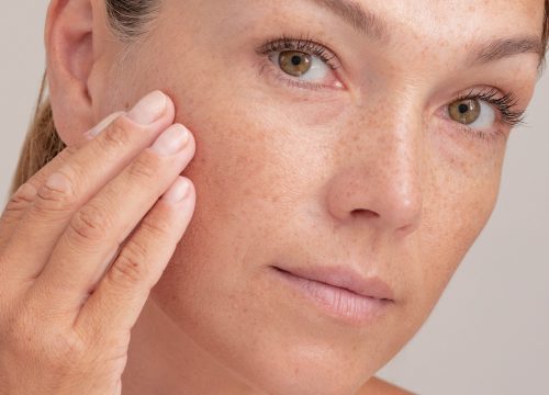 Brown Spot Removal in North Carolina | Avail Aesthetics