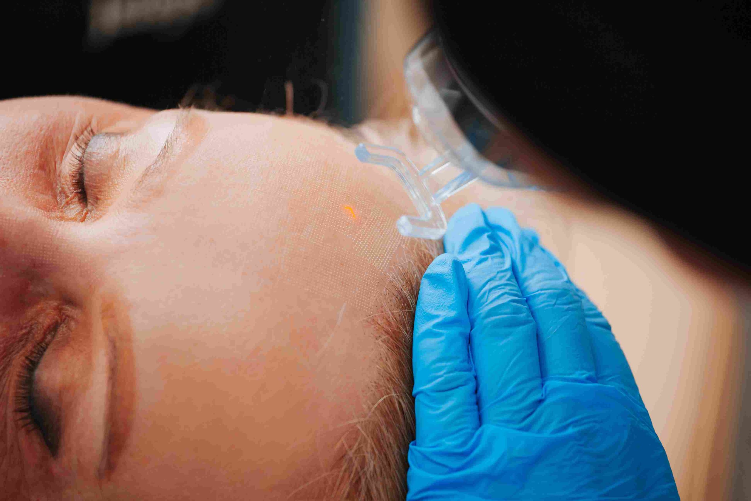 Woman Undergoing Tetra CO2 Coolpeel Treatment on her Face | Avail Aesthetics in Raleigh, NC