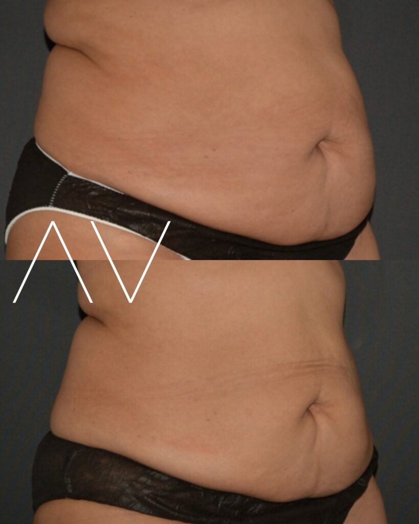 coolsculpting wake forest nc