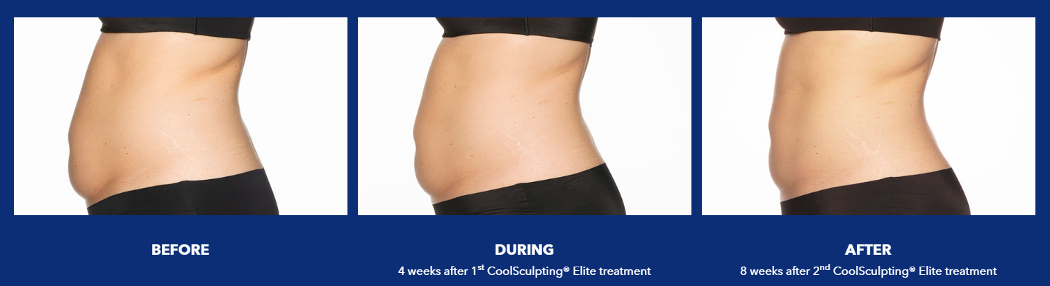 coolsculpting wake forest nc - before, during and after treatment